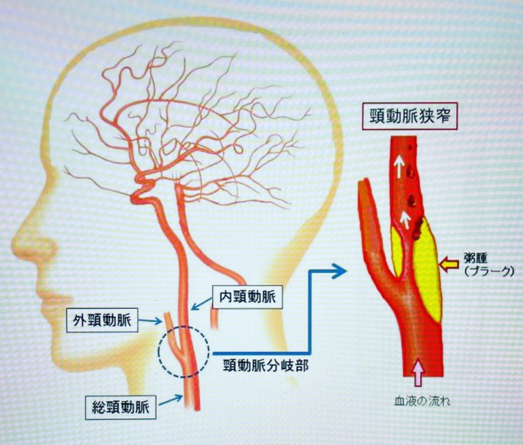 #頸動脈狭窄症について！頸動脈が狭くなった時の症状言葉が出にくい手足が痺れる手足を上手く動かせないなど！