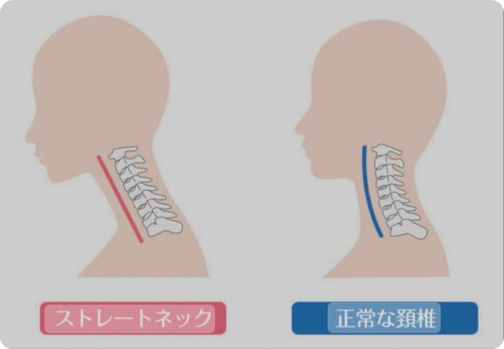 #ストレートネック！首の骨の部分のカーブが消失し、真っ直ぐになってしまった状態をストレートネックと言います。